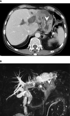 Intraductal papillary neoplasm of the bile duct presenting with hepatogastric fistula: a case report and literature review